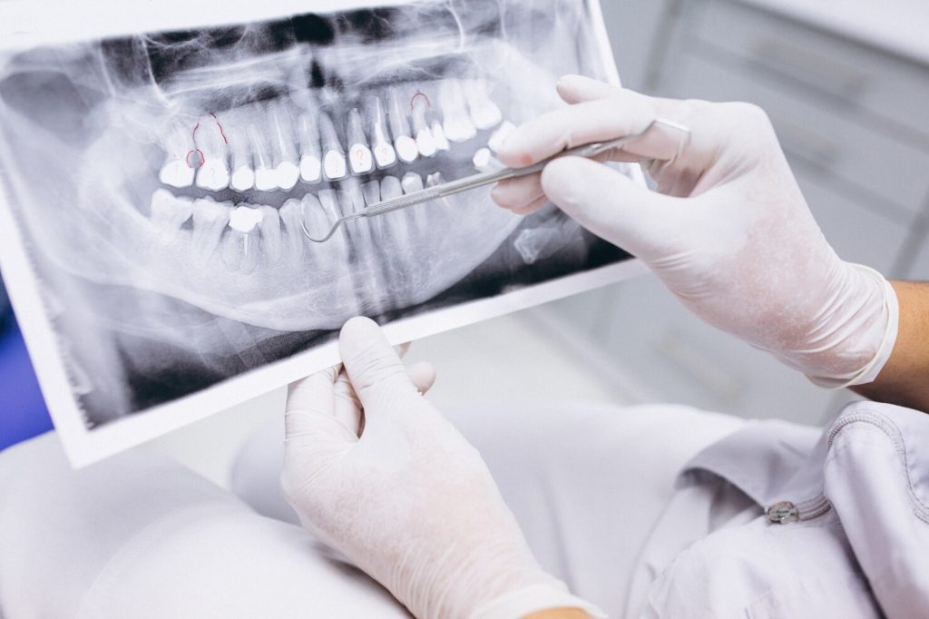 Czym jest resorpcja korzenia zęba?